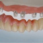 Der Zweikomponenten-Komposit Kleber zum verkleben prothetischer Versorgungen