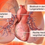 Pulmonale Hypertonie (PH) - Verengung der Lungenarterien