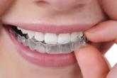 Niemand wird Ihre Zahnregulierung bemerken