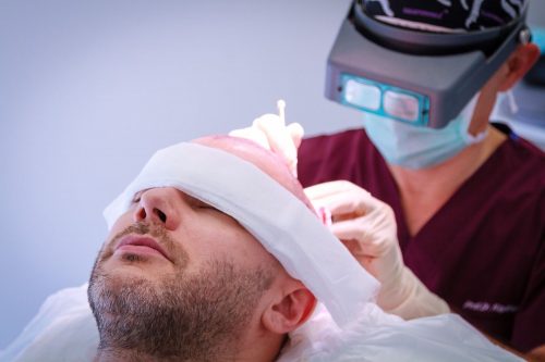 Schütteres Haar kann eine seelische Belastung darstellen Mann während des Eingriffs